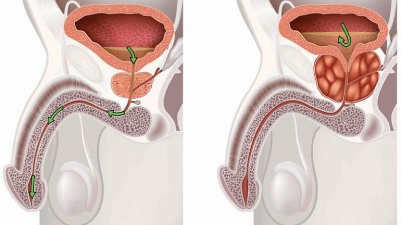 estancamiento de la orina sobre la prostatitis