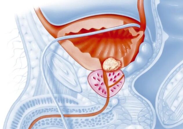 Características de la prostatitis crónica.